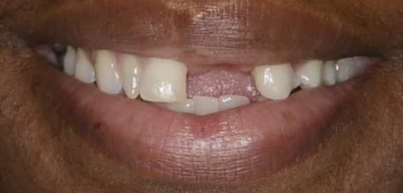 Tooth Implant before