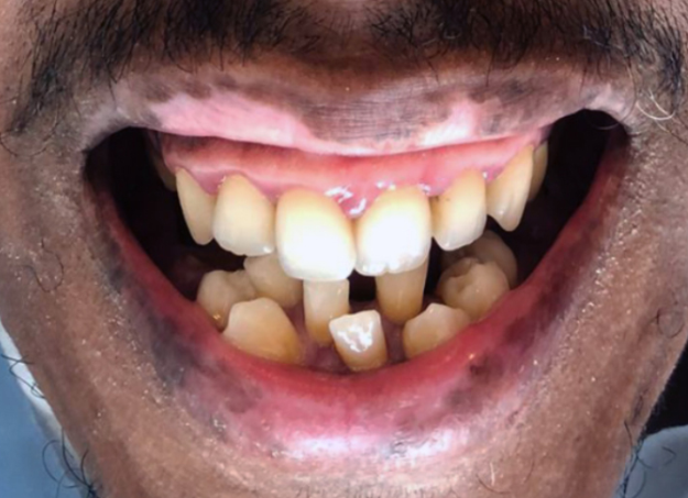 Stacked teeth before